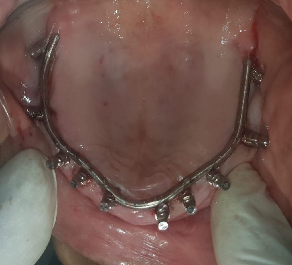 intra oral welding